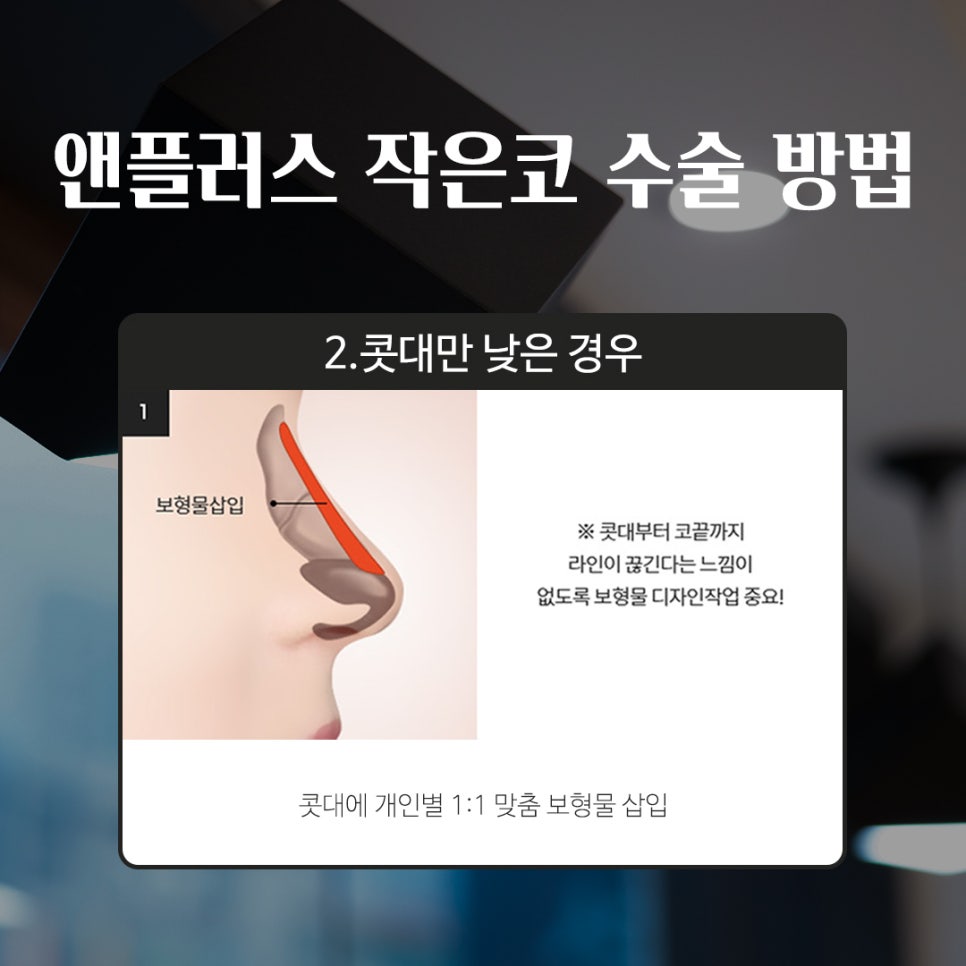 성형하기 힘든 코유형 관련 이미지 5