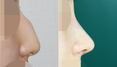 메부리코교정 사진 관련 이미지 1