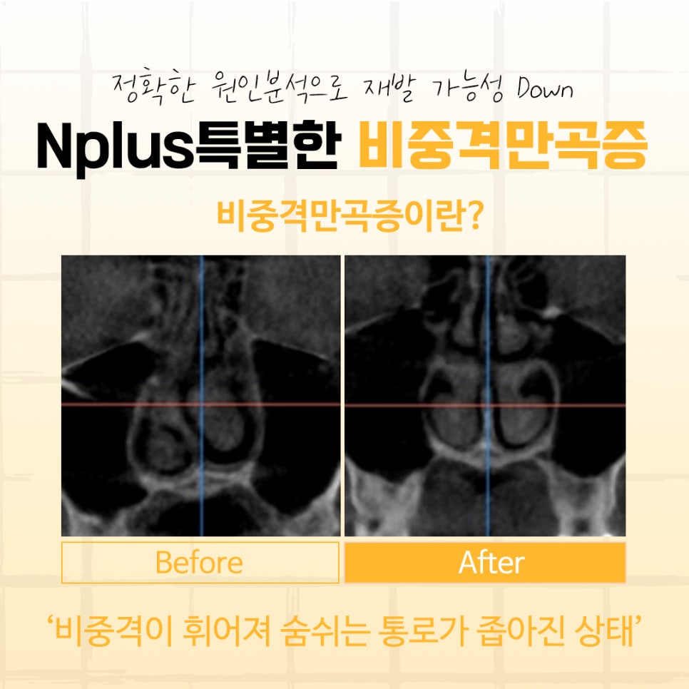 비중격만곡증수술후기에 대해 신중하게 찾아보고 관련 이미지 6