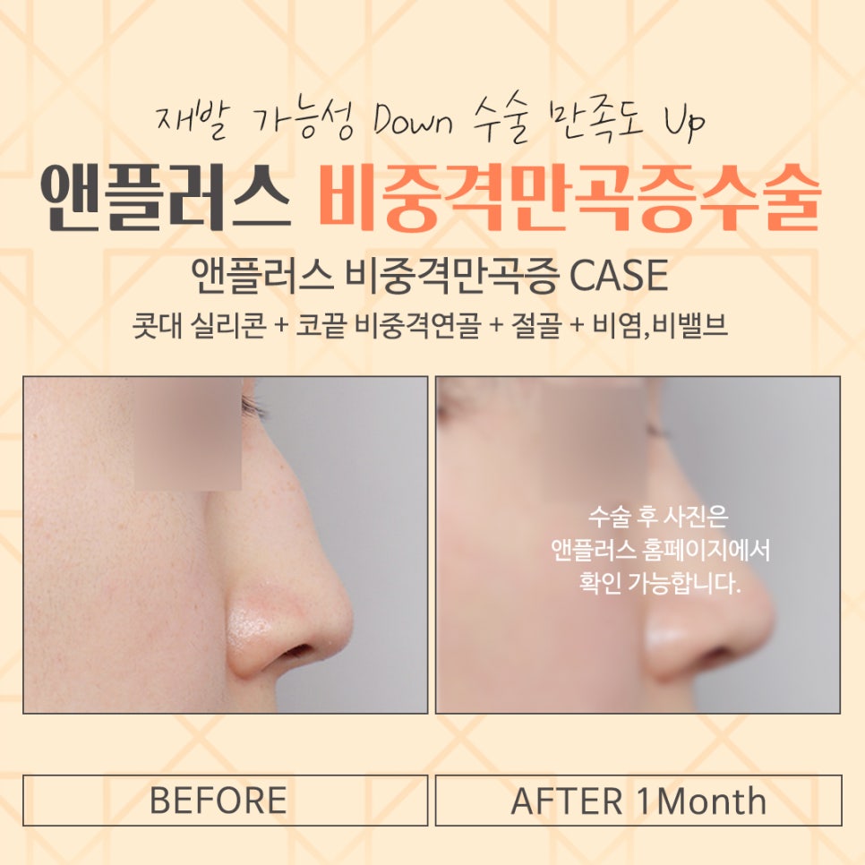 비중격만곡증수술후기 코 내부를 정확하게 파악해야 관련 이미지 17