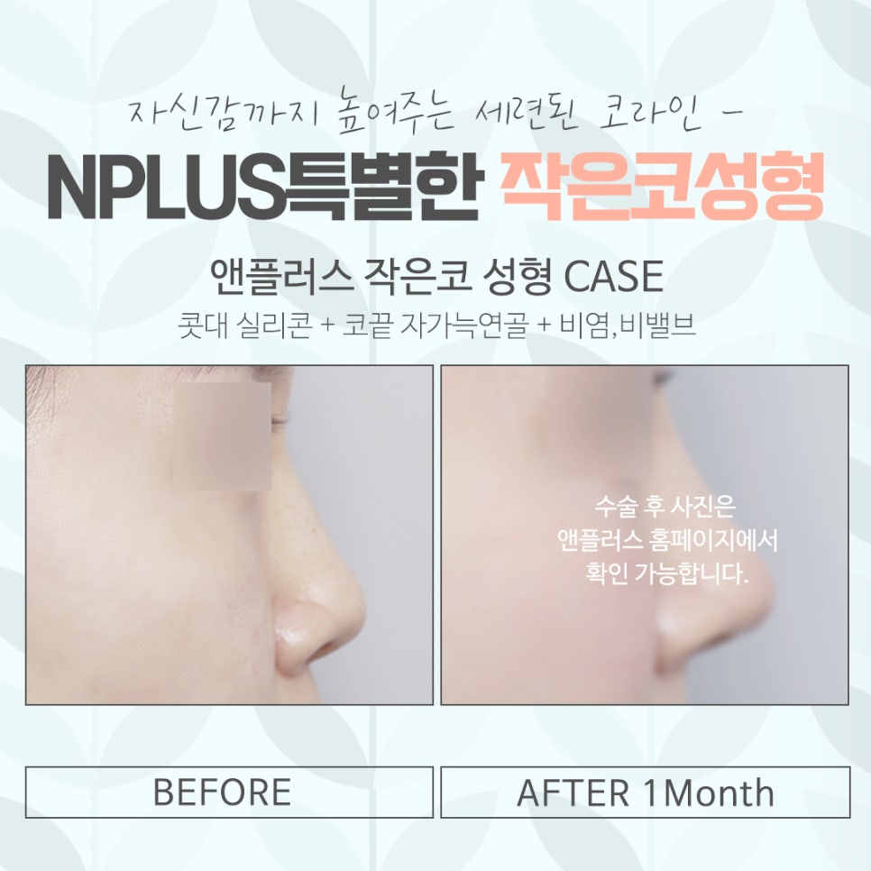 작은코수술을 통해 입체적인 라인으로 관련 이미지 13