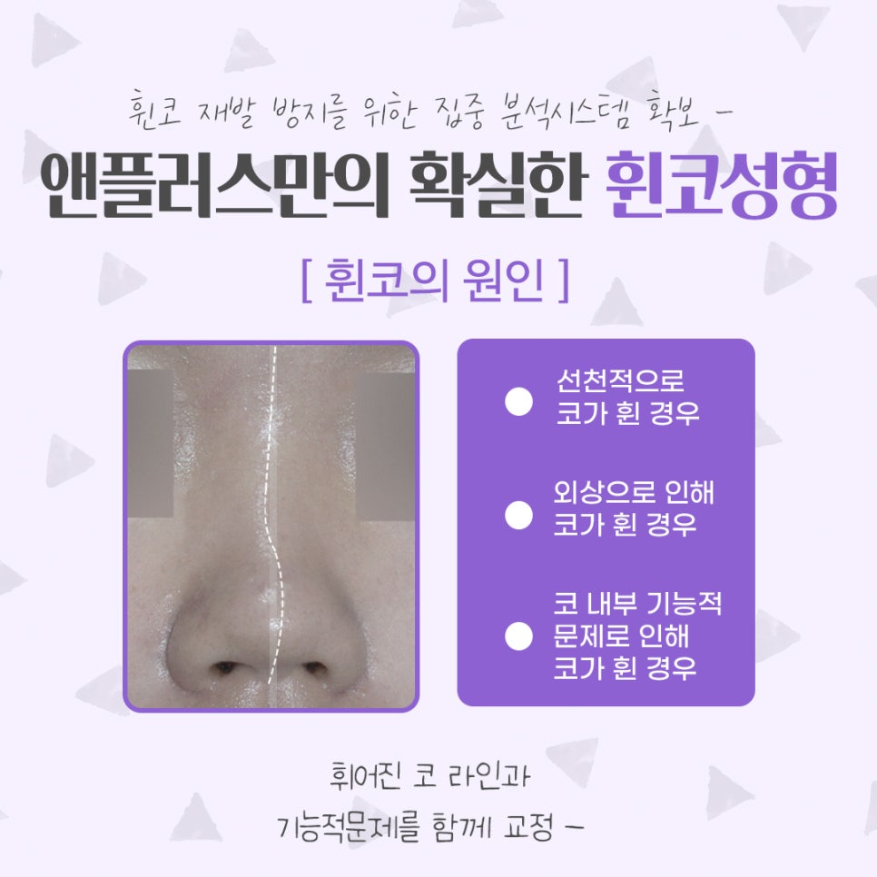 Bent Nose Surgery Review: With an Accurate Diagnosis image 4