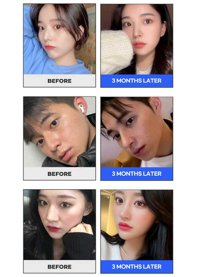 앤플러스의원 자가늑코성형 이벤트😍 관련 이미지 5