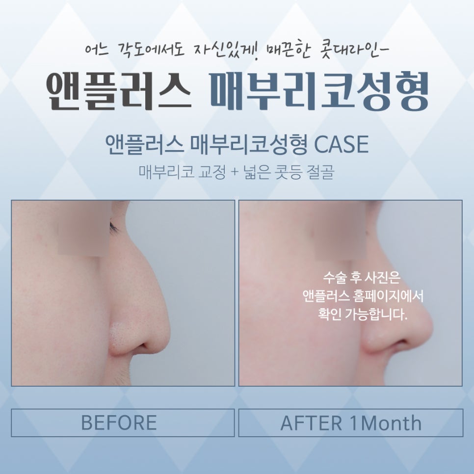 Looking into Cases of Before and After Hump Nose Surgery image 13
