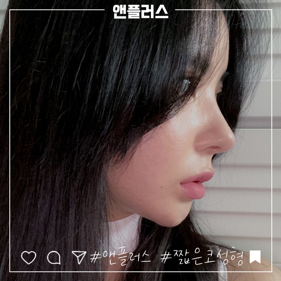 A Beautiful Nose Line with Short Nose Surgery image 7