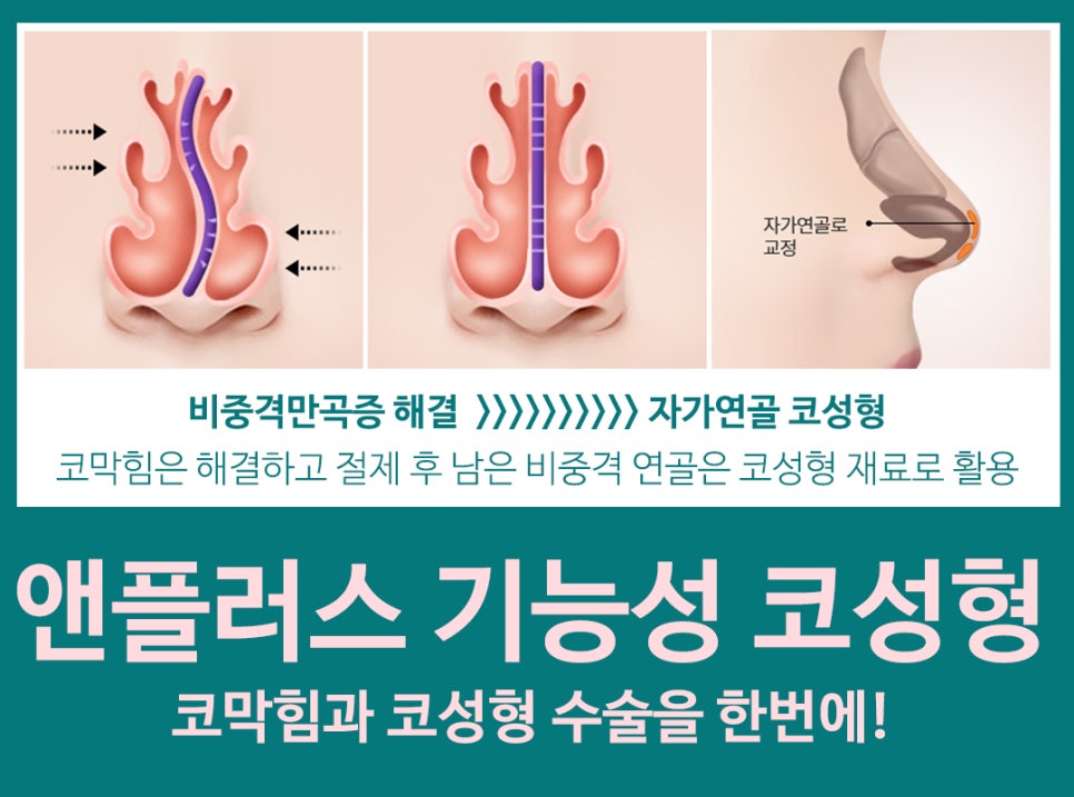 비염실비 꼼꼼하게 알아보고 체크하자 관련 이미지 3