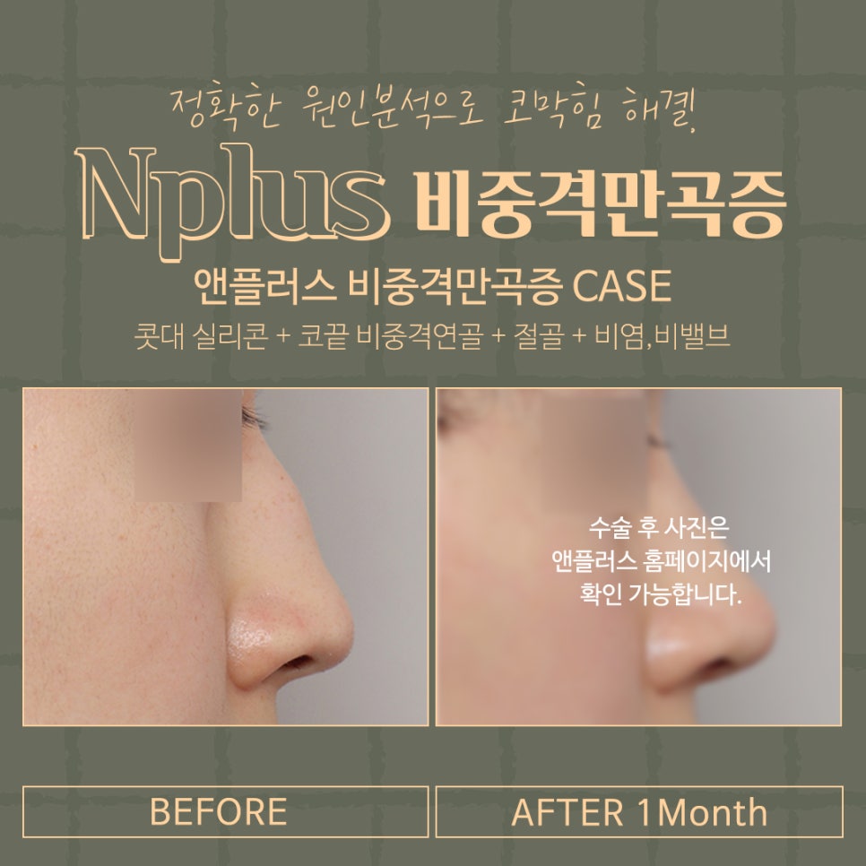 Septoplasty Surgery Explained at Gangnam Nose Surgery image 13