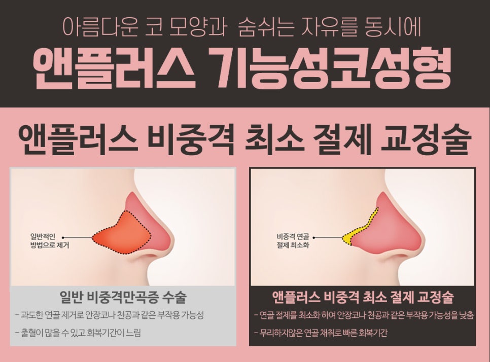 보험이 되는 코성형? 기능성코성형 완벽 정리! 관련 이미지 5