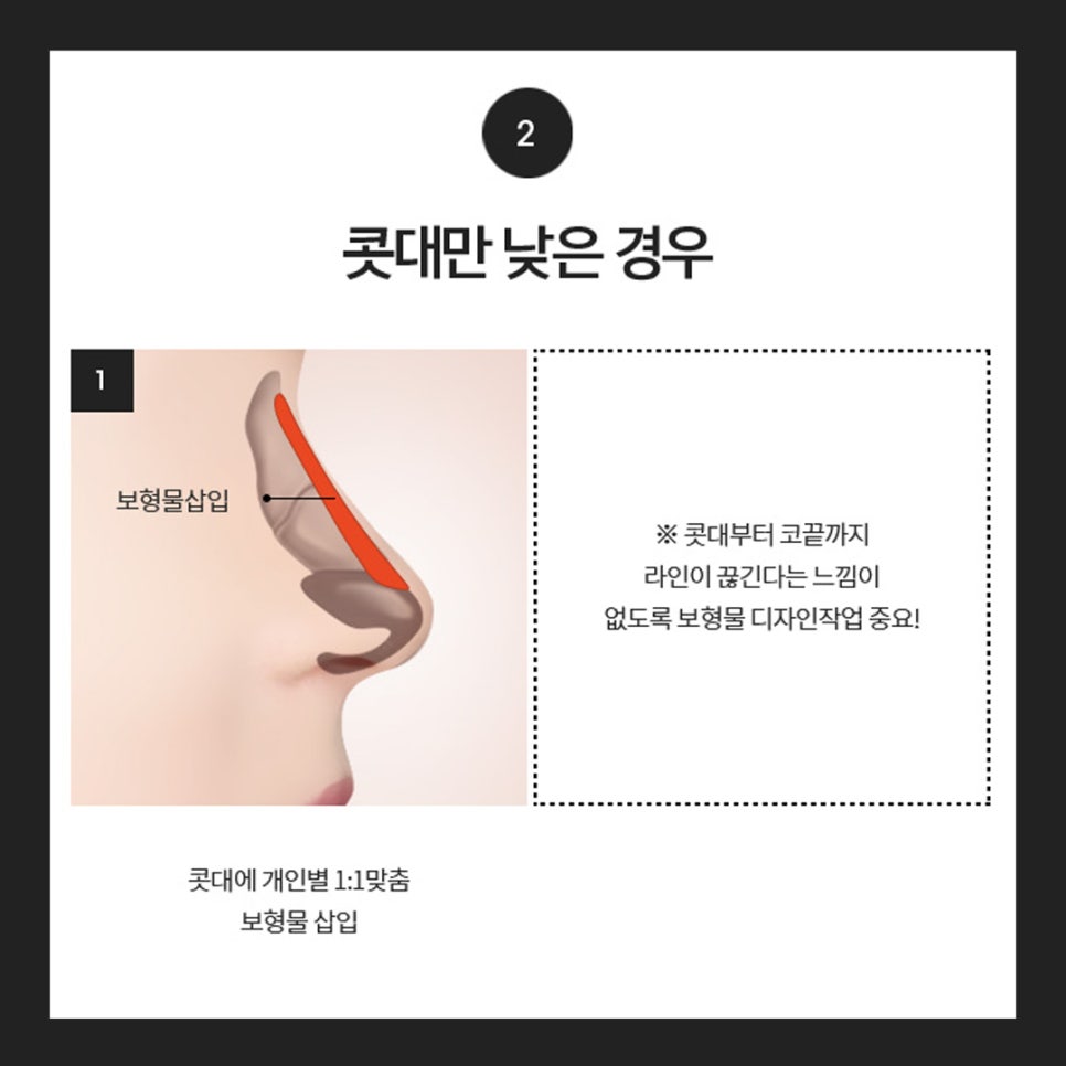 Let’s Find Confidence with a Small, Low Nose and a Beautiful Nose Shape! image 7