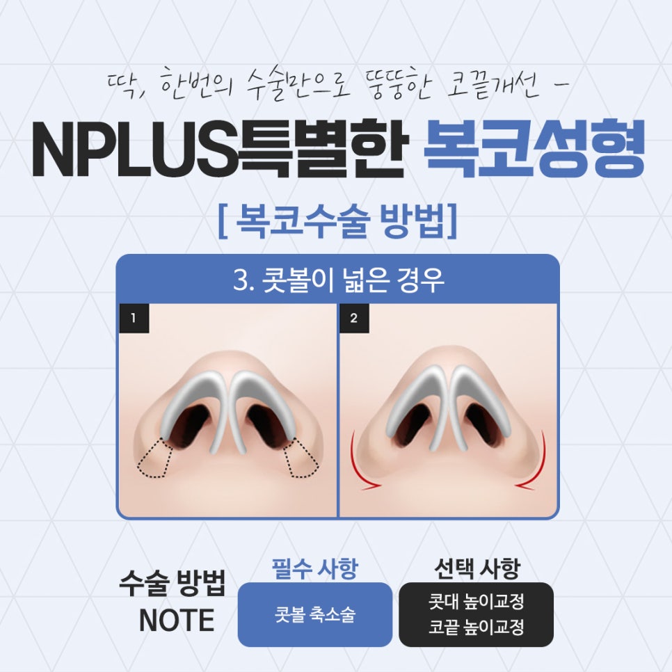 Broad Nose Surgery Review for a Refined Look image 9