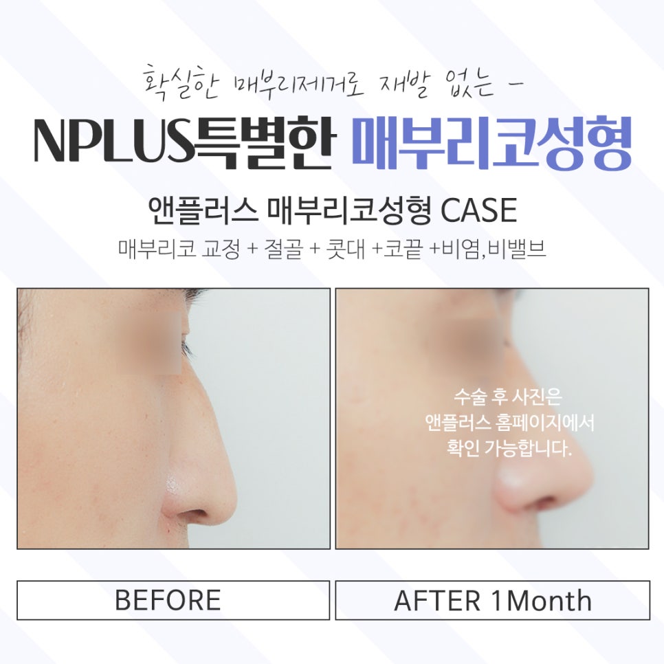 Learn About Hump Nose Surgery Reviews Accurately image 16