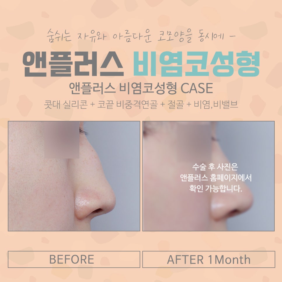 오지코에서 알려드리는 비염코수술 관련 이미지 13