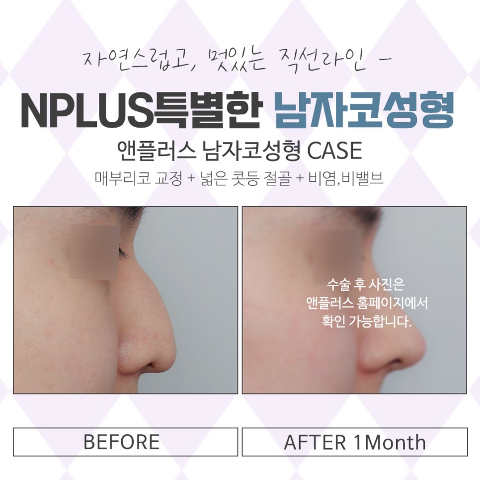 남자코성형후기 자세하게 알아보고 관련 이미지 15