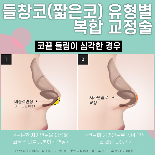 짧은코성형 복합적 교정방법 관련 이미지 5