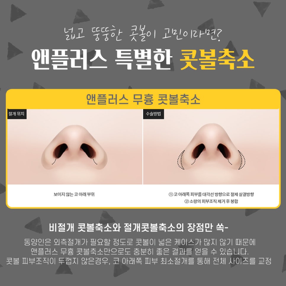 콧볼축소후기_넓은콧볼 고민해결 관련 이미지 5
