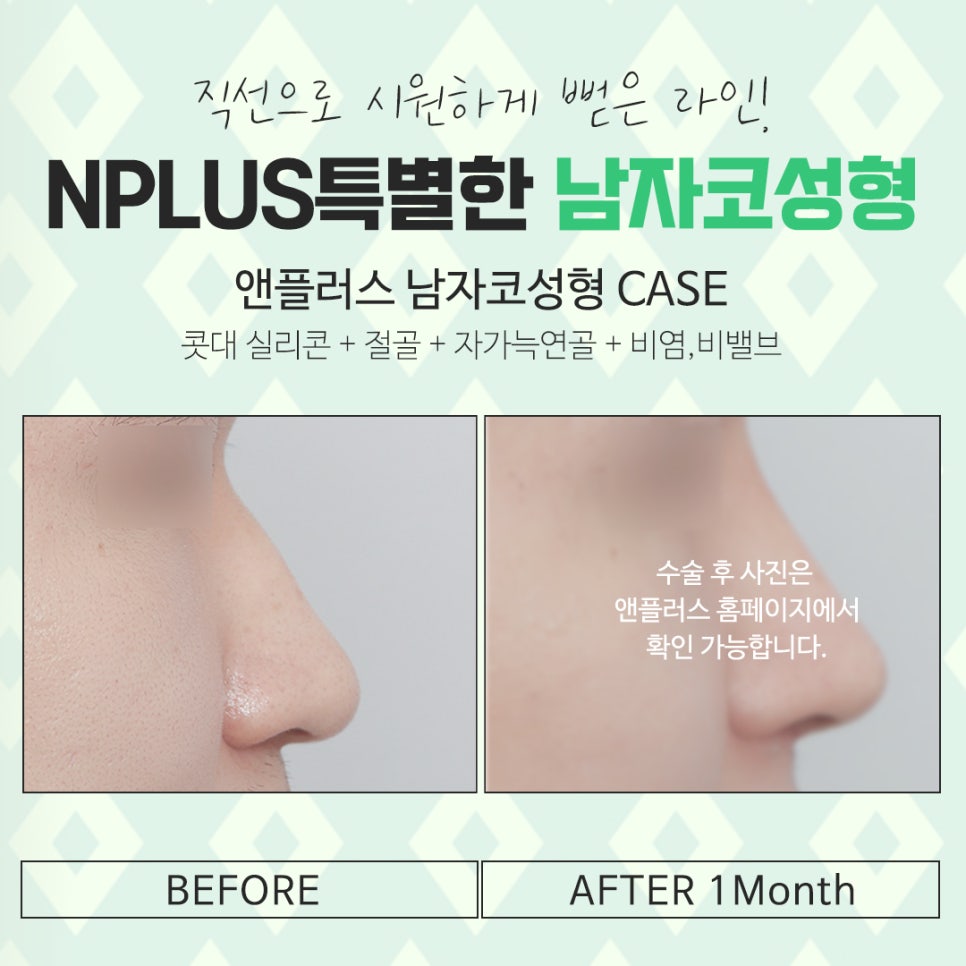 Learn About Before and After Male Nose Surgery in Various Ways image 14