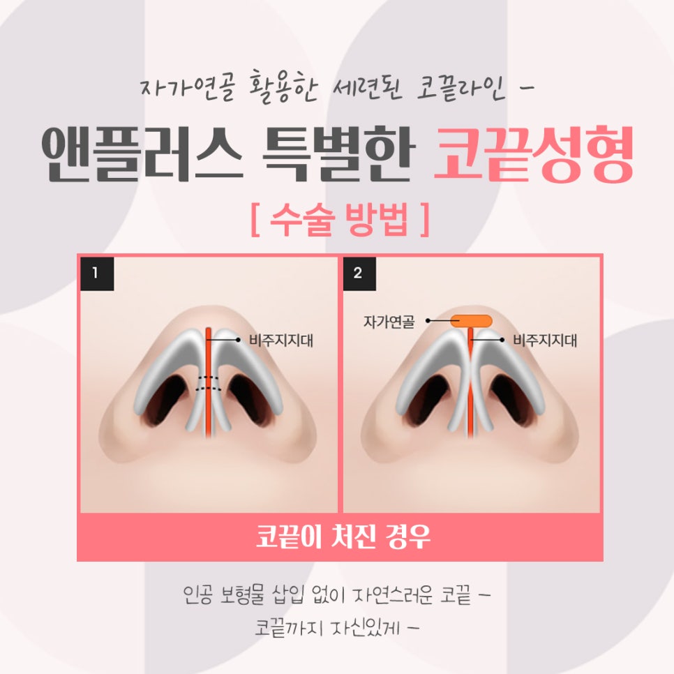 코끝성형후기로 세련된 코 라인 관련 이미지 10
