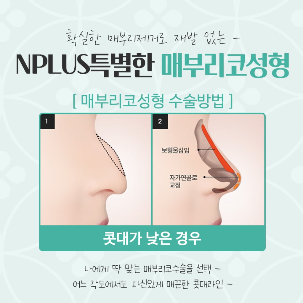 매부리코수술후기 자연스럽고 세련된 라인으로 관련 이미지 9