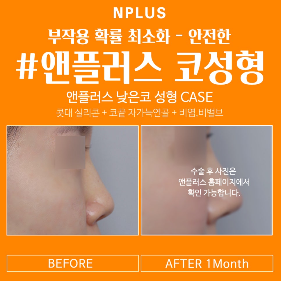 Increased Confidence with Low Nose Surgery image 2