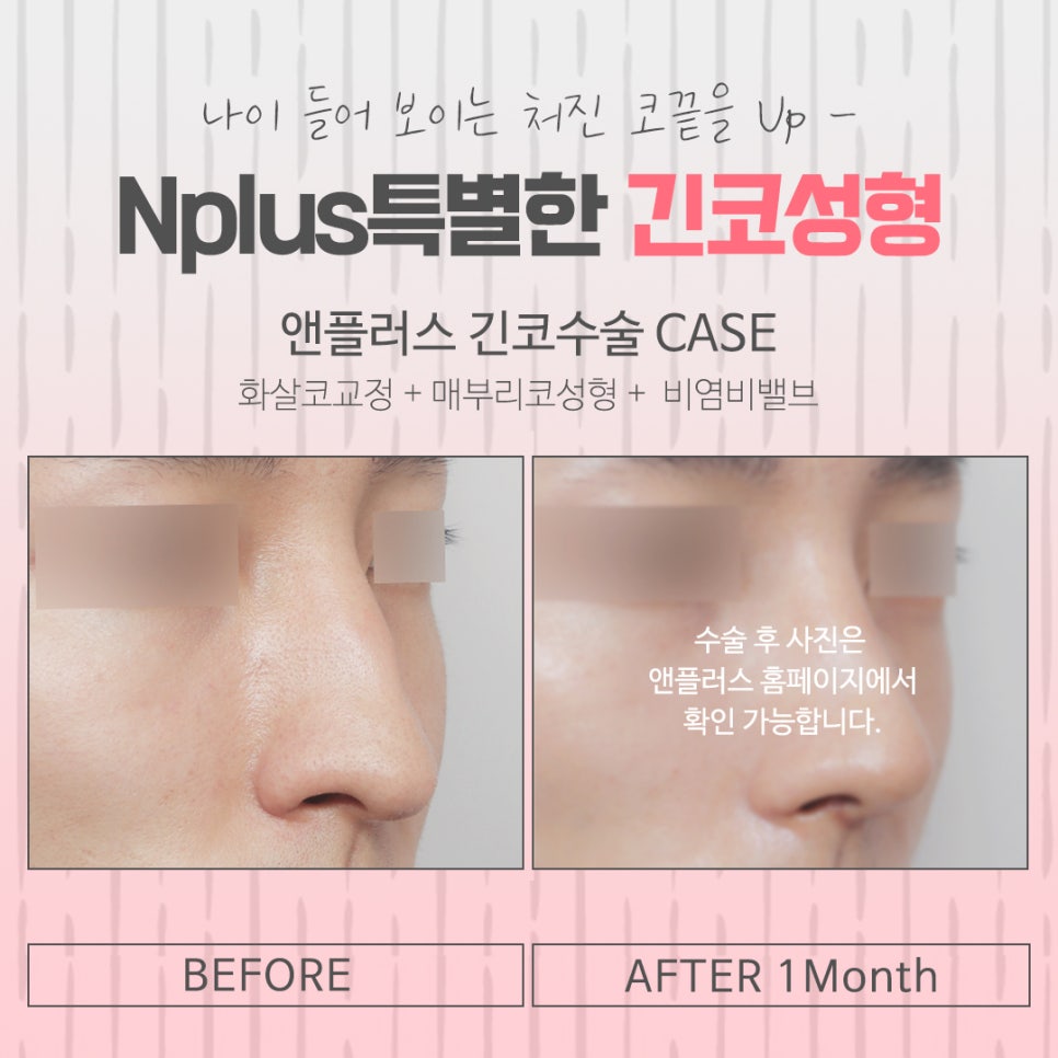 긴코성형 자연스럽게 교정하여 관련 이미지 15