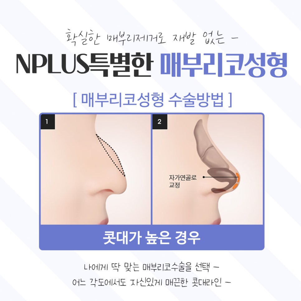 Learn About Hump Nose Surgery Reviews Accurately image 9