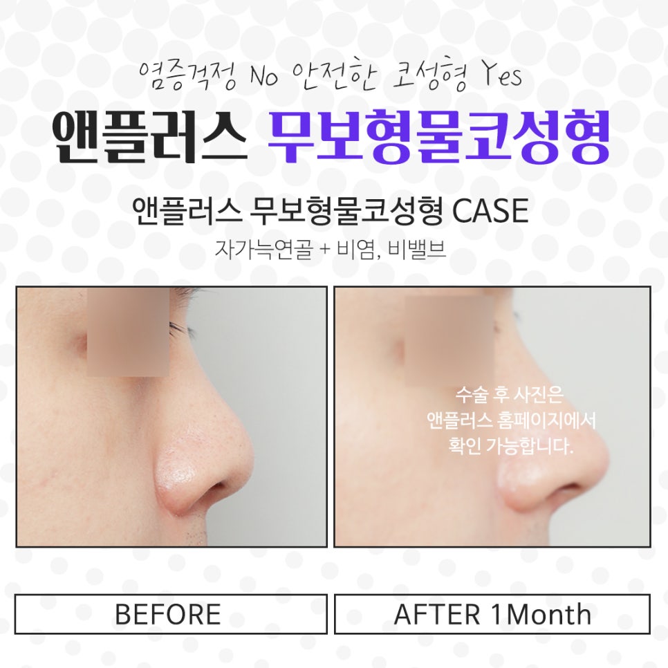 Carefully Reviewing Reviews of Non-Implant Nose Surgery image 11