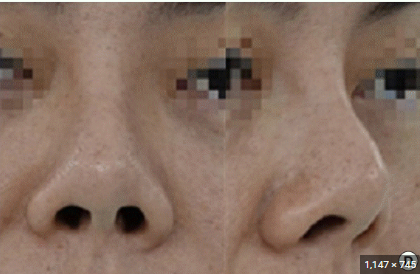 코재건 수술할때 꼭 알아두어야 할 상식! 관련 이미지 9