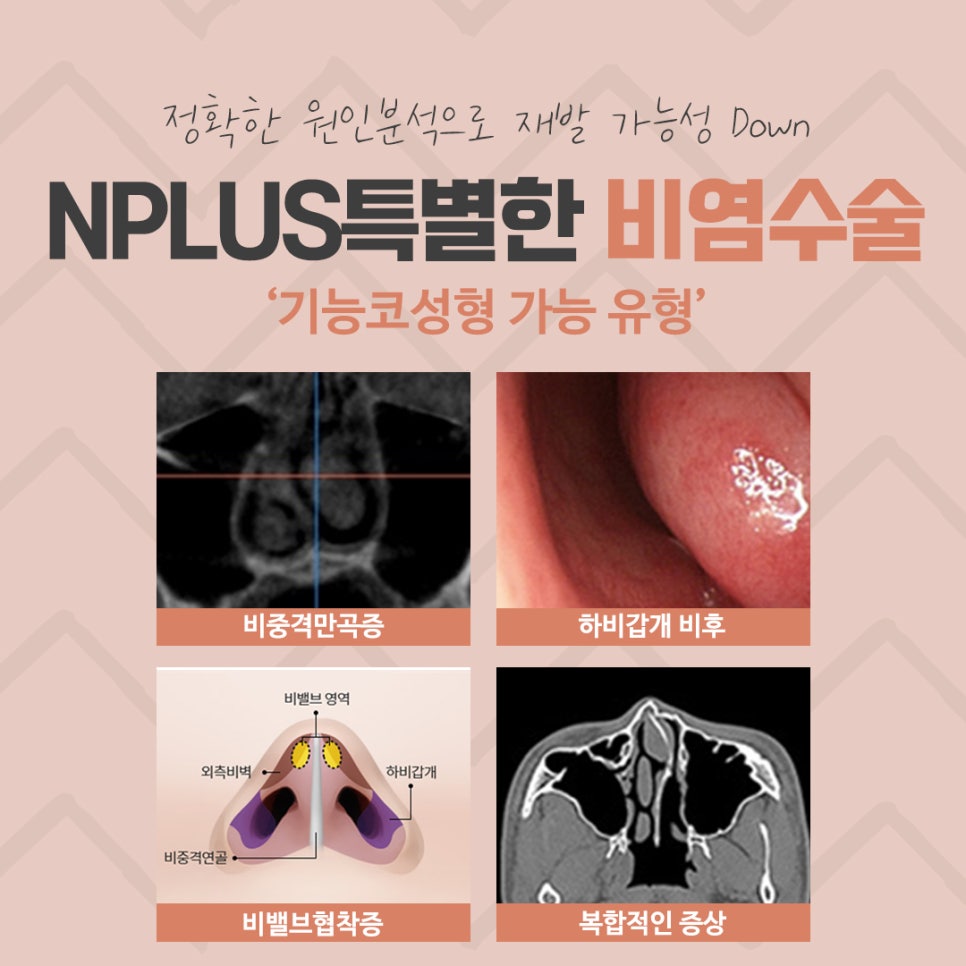 비중격수술후기 정확하게 파악해야 관련 이미지 6