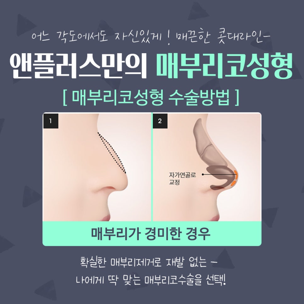 매부리코성형후기 매끈하고 예쁜코라인으로 관련 이미지 11