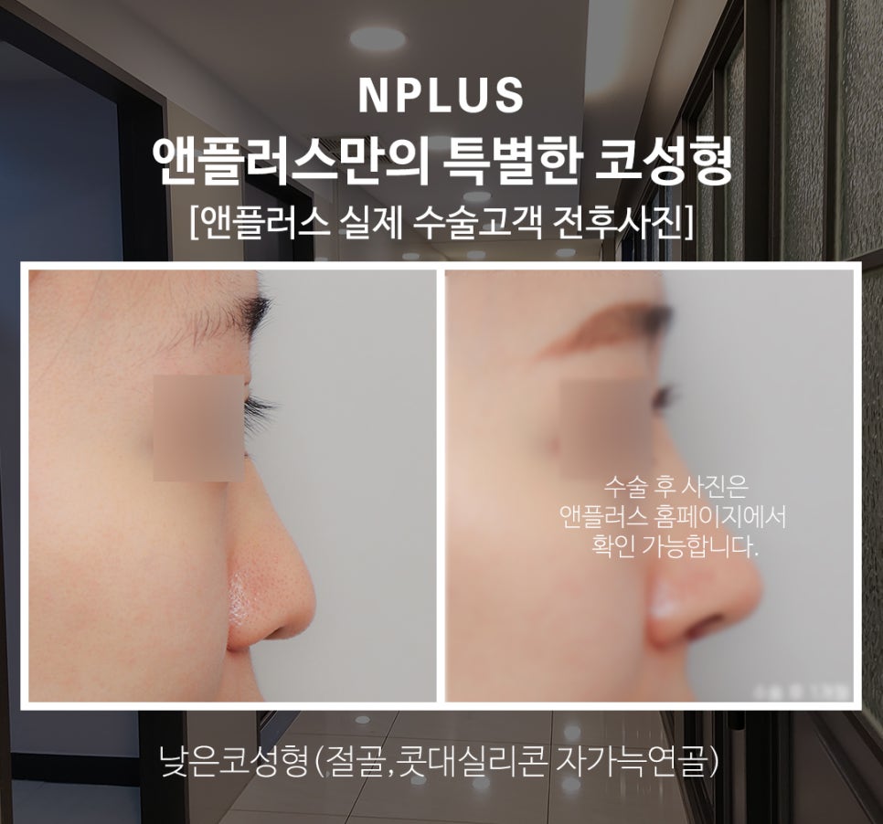 자가늑연골코성형 으로 코재수술 고민 해결 관련 이미지 9