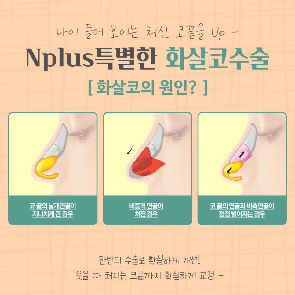 화살코수술 후기까지 알아보고 결정 관련 이미지 5