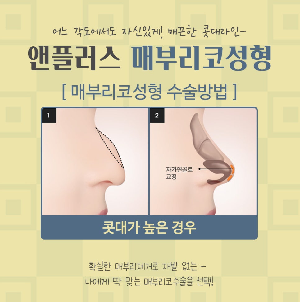 Nose Surgery Review for Correcting a Hump Nose image 9