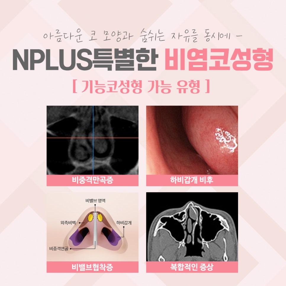 비염코수술후기 확실한 진단으로 관련 이미지 4