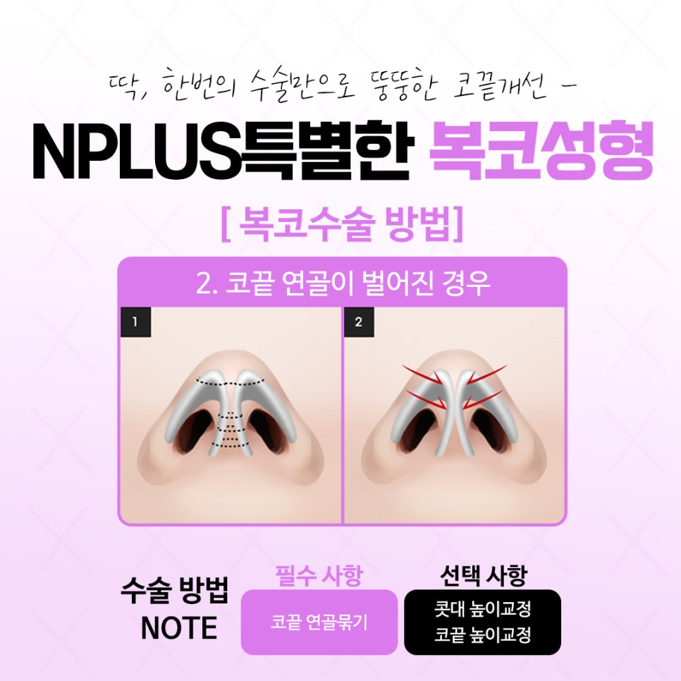 복코수술후기 날렵하고 세련된 라인으로 관련 이미지 8