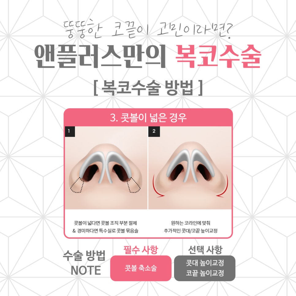 복코수술후기 뚱뚱한 코끝 개선 관련 이미지 7