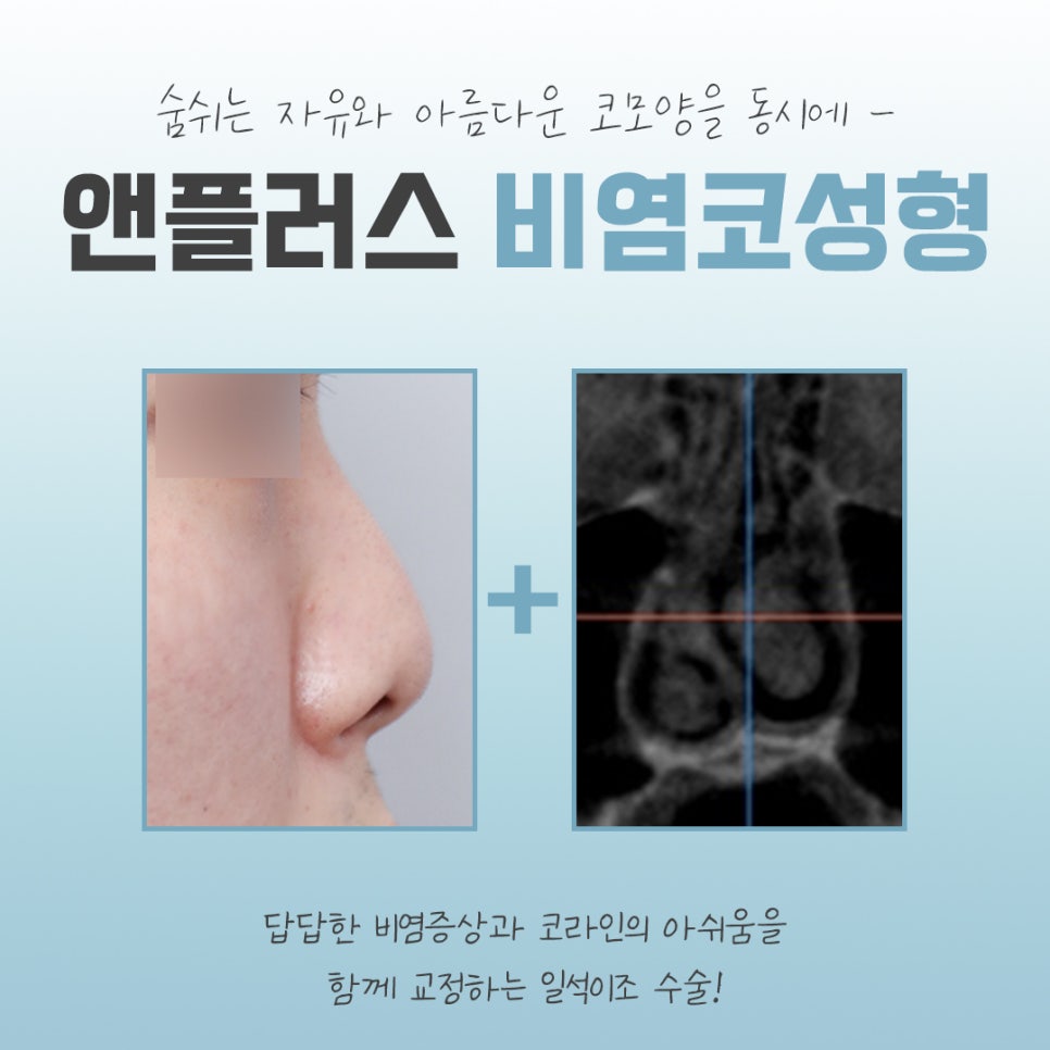 비염코수술전후에 대해 자세히 알아보고 관련 이미지 3
