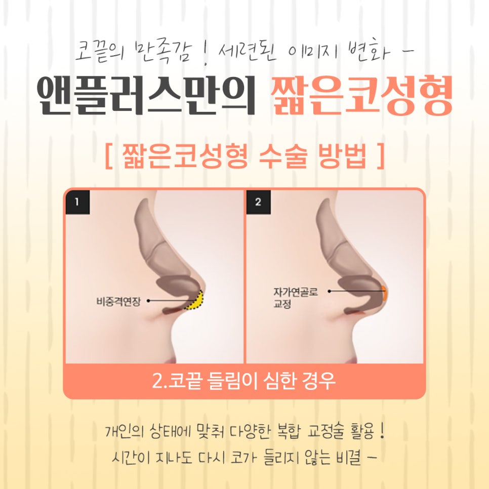 Addressing the Problems of Short Nose Surgery image 9