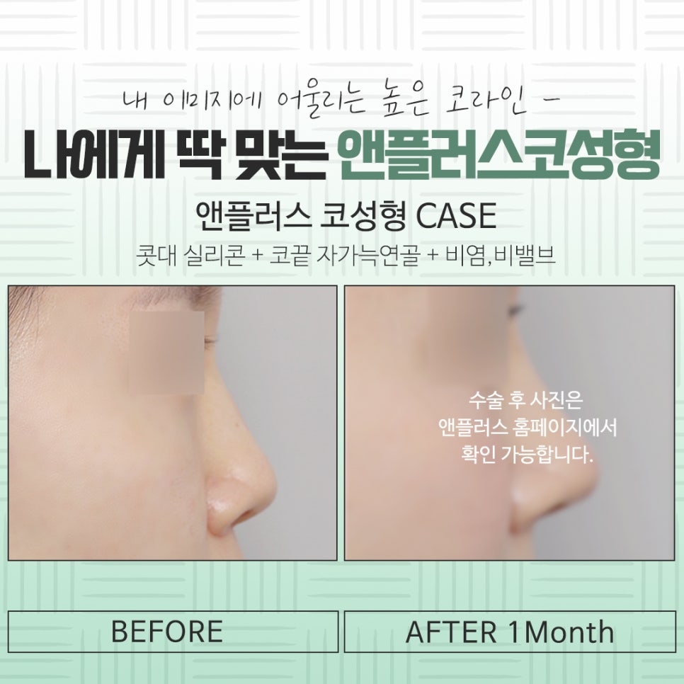Check the Difference in Autologous Rib Nose Surgery Results image 15