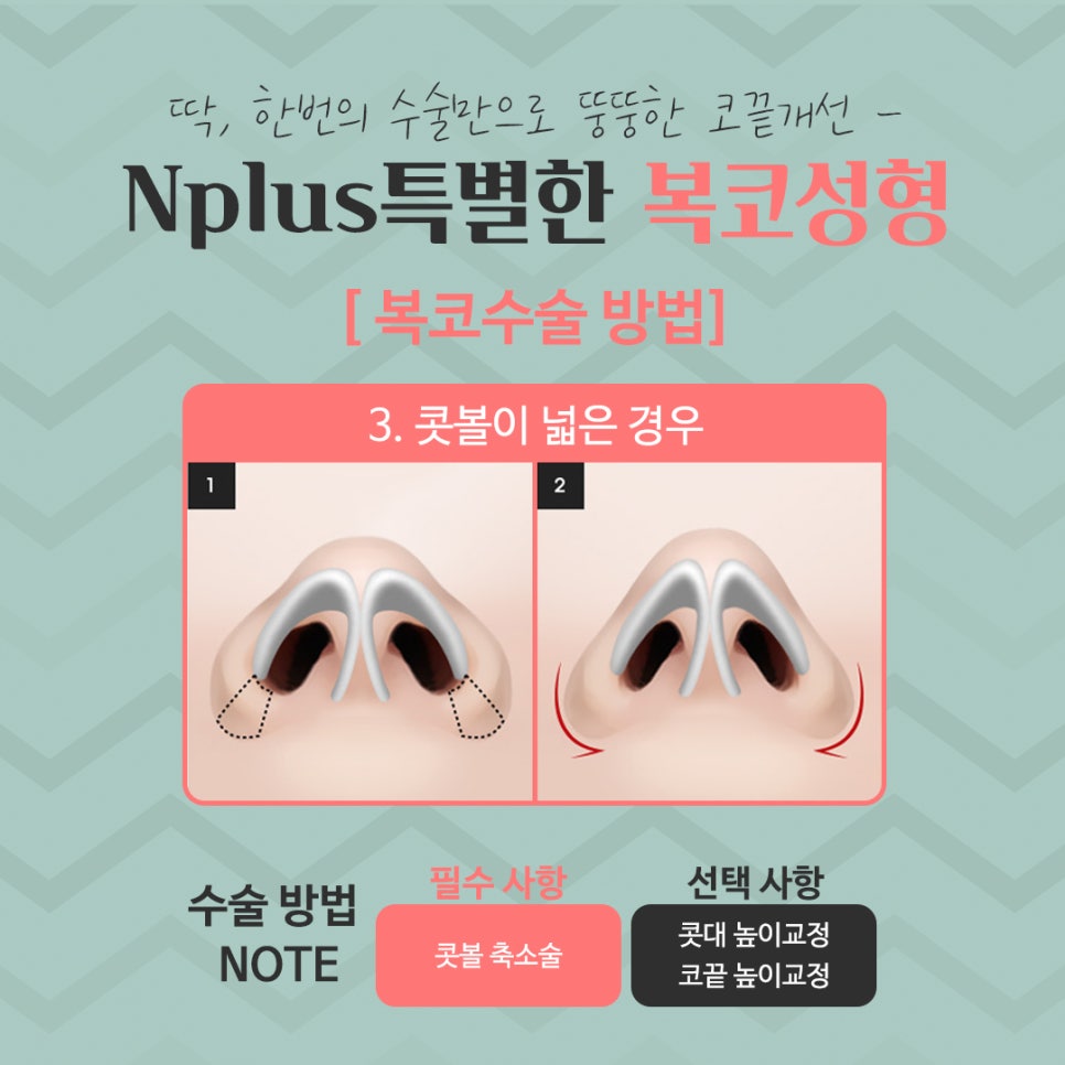 복코수술후기 세련된 인상으로 관련 이미지 10
