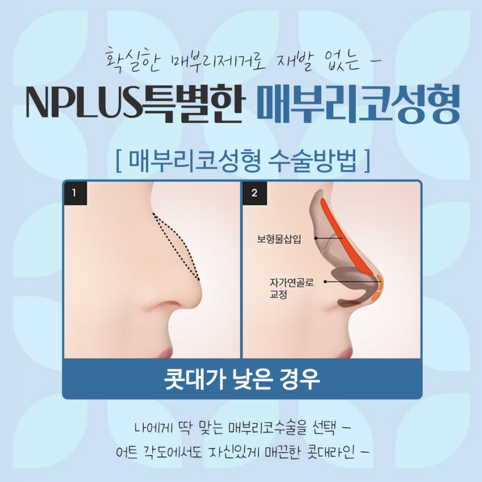 남자매부리코 원인을 정확하게 파악하고 관련 이미지 10