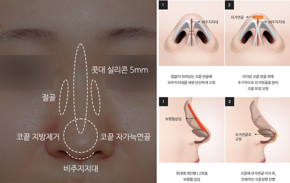 Creating a Straight-But-Slightly-Curved Nose Line with Columella Reduction image 7