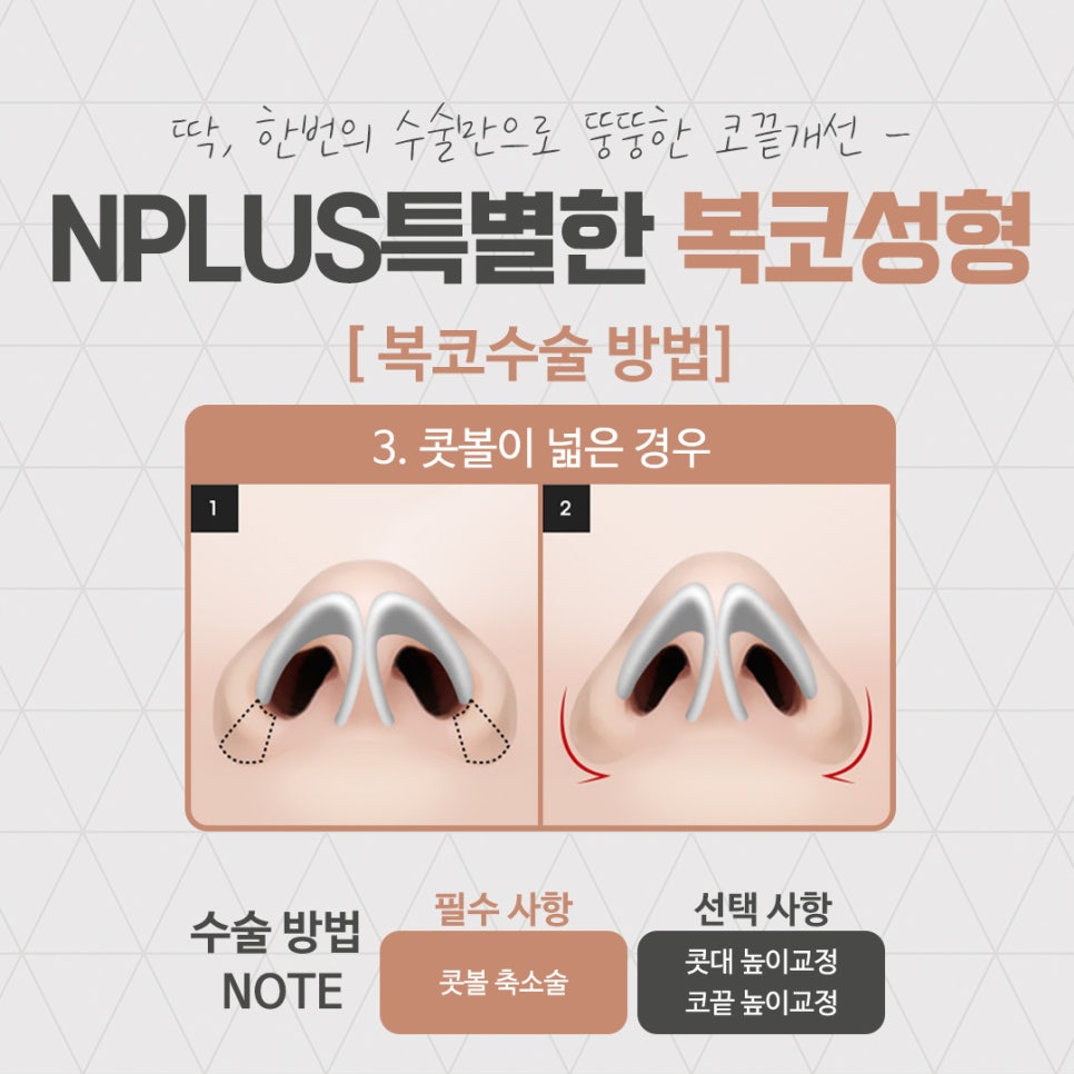 복코성형후기를 다양하게 찾아보고 관련 이미지 10