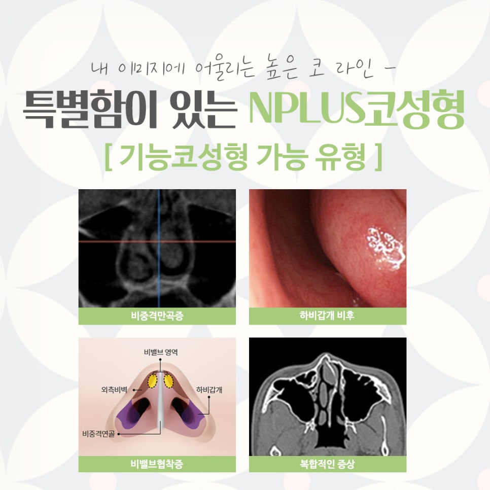 코수술잘하는곳에서 예쁘고 자연스럽게 관련 이미지 6