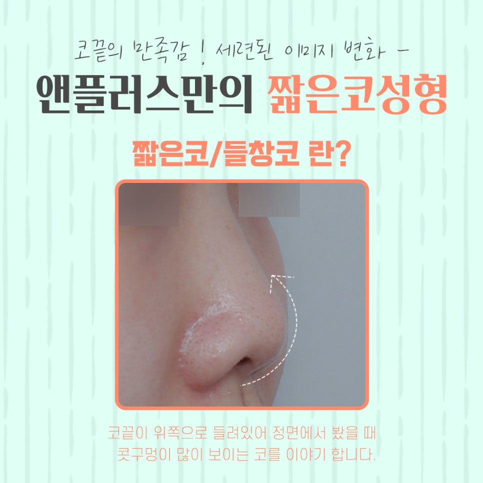 Short Nose Surgery with an Accurate Diagnosis image 5