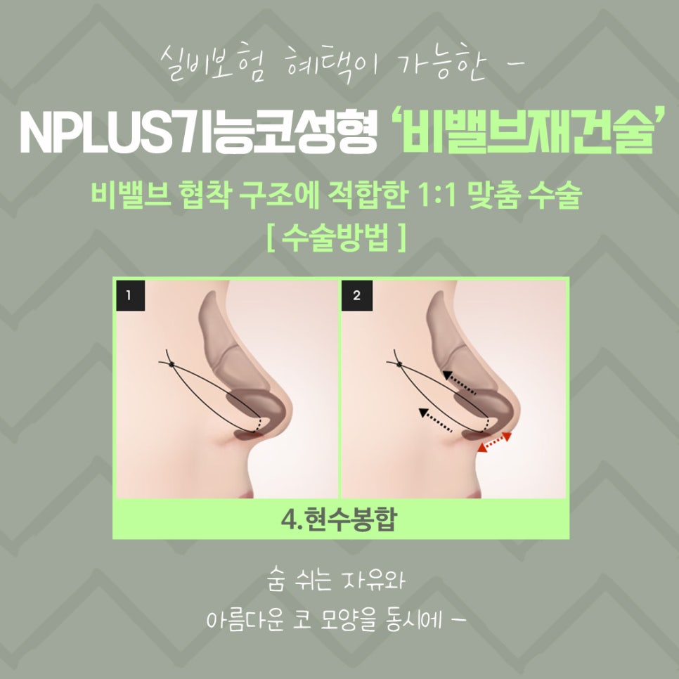 비밸브재건술을 통한 숨 쉬는 자유 관련 이미지 12