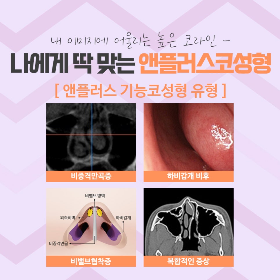 코수술후기 코 내부까지 확실하게 알아보고 관련 이미지 13