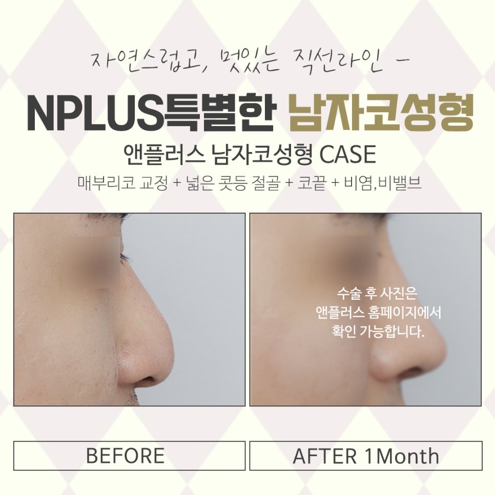 Male Nose Surgery Review: If You Want an Improved Appearance image 15