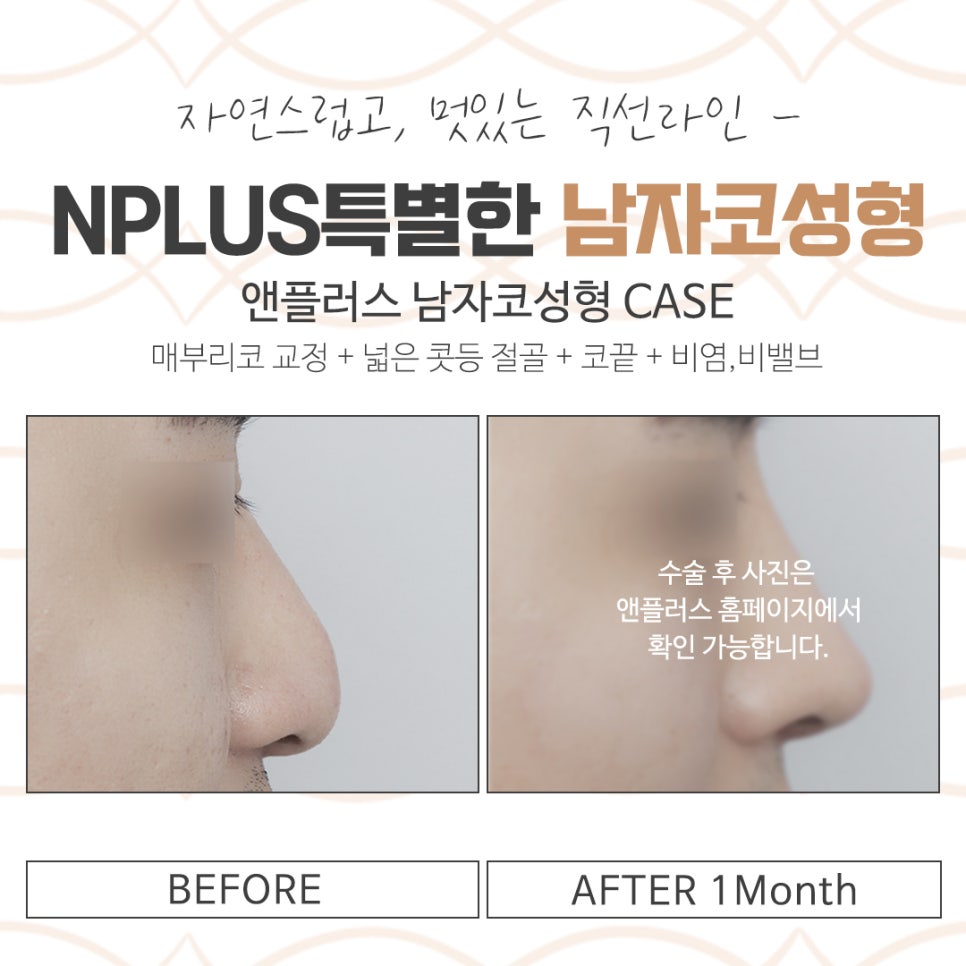 남자코성형전후 확인하고 개선 관련 이미지 15