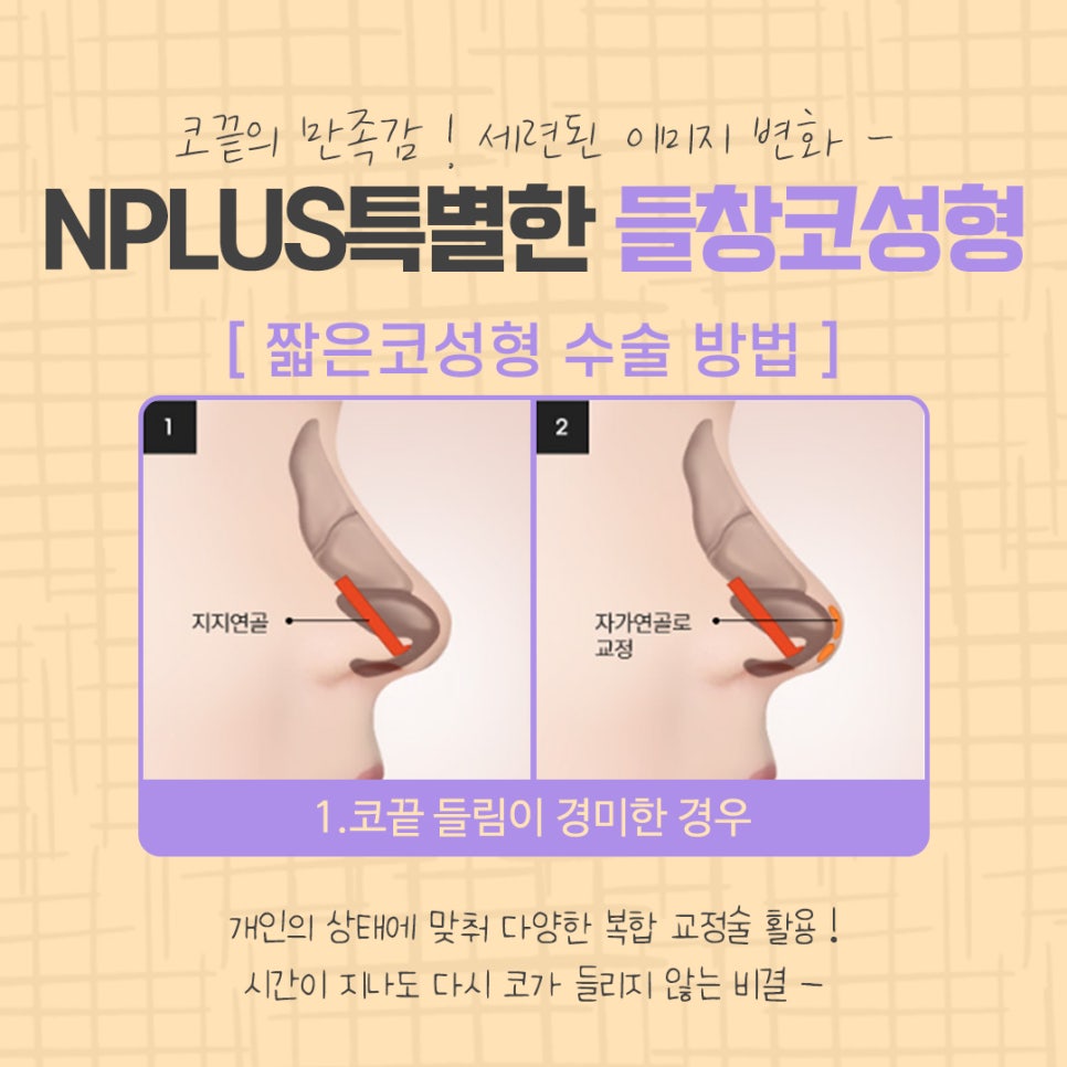 들창코성형 후기까지 알아보고 관련 이미지 8