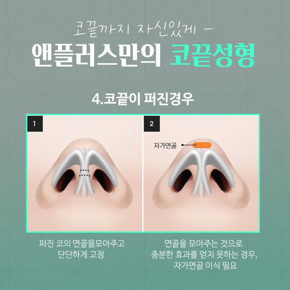 Improving the line through tip cartilage suturing image 10